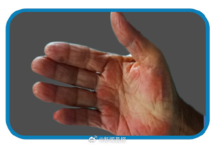 别大意!身上长小红点,可能是疾病危险信号 别大意!身上长小红点,可能是疾病危险信号