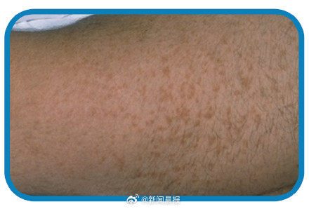 别大意!身上长小红点,可能是疾病危险信号 别大意!身上长小红点,可能是疾病危险信号