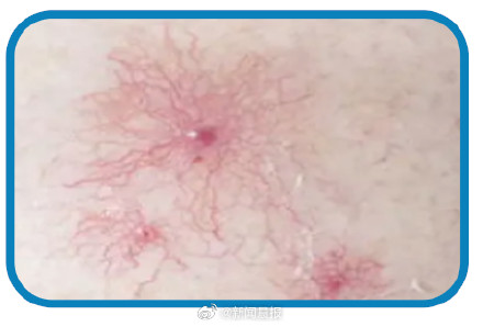 别大意!身上长小红点,可能是疾病危险信号 别大意!身上长小红点,可能是疾病危险信号