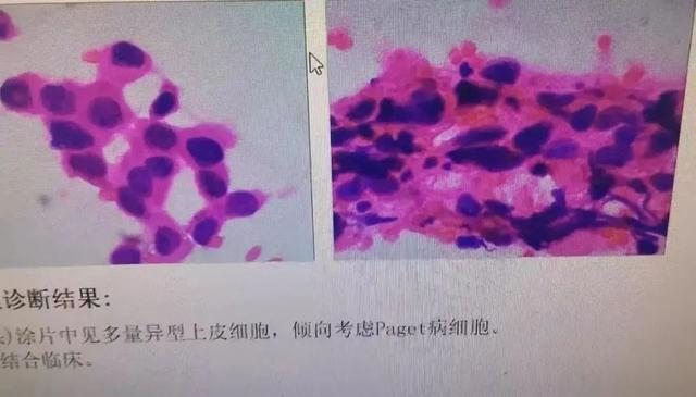 以为是湿疹,结果竟是癌!医生:很多患者去错科室 以为是湿疹,结果竟是癌!医生:很多患者去错科室