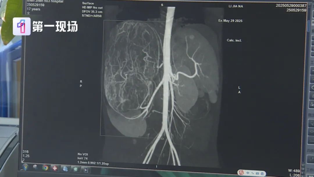 17岁女孩买衣服时经店员一句提醒,发现体内藏着“巨大肿瘤”!这一点家长要注意 17岁女孩买衣服时经店员一句提醒,发现体内藏着“巨大肿瘤”!这一点家长要注意