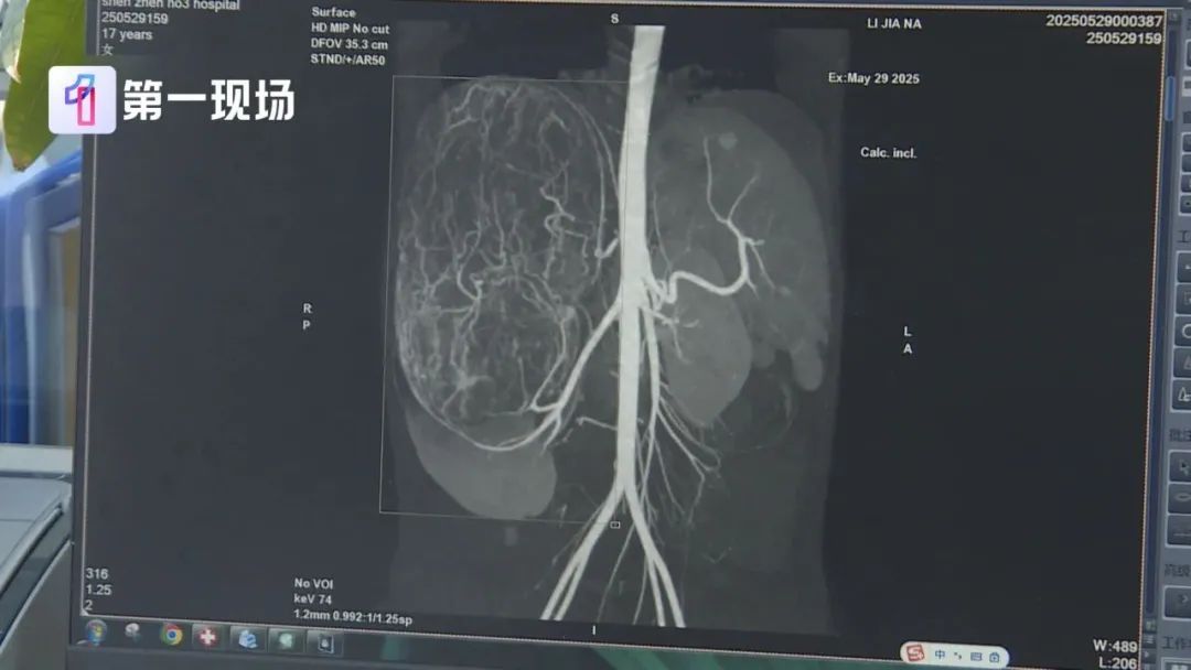 买衣服时店员看出问题,17岁女孩查出恶性肿瘤 买衣服时店员看出问题,17岁女孩查出恶性肿瘤