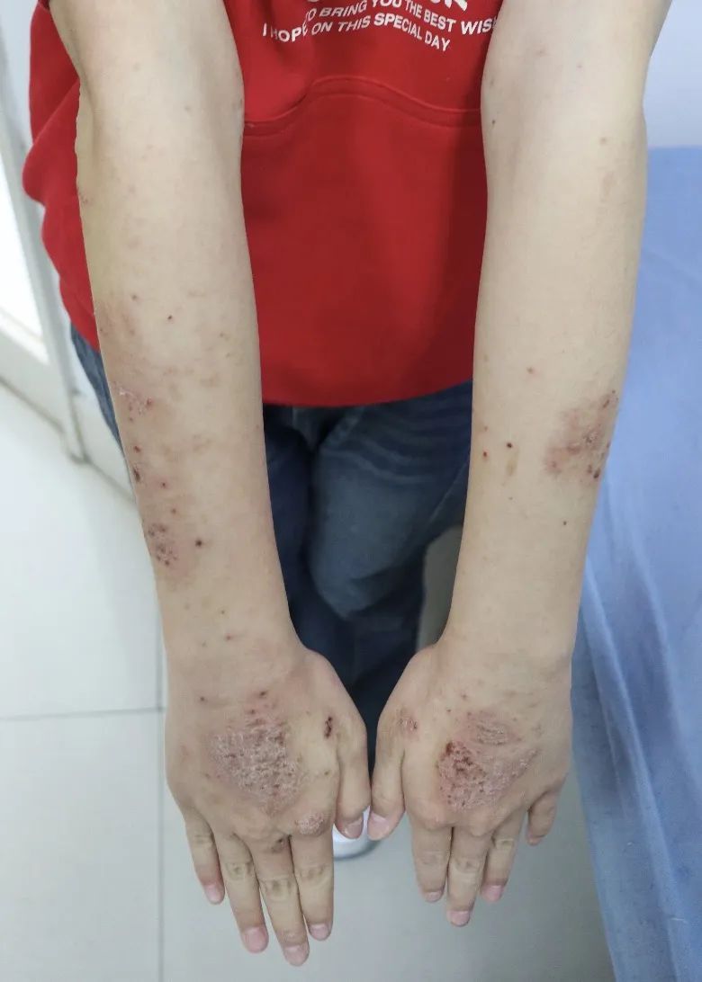 集中爆发!沪上这类人一到黄梅天就遭殃:晚上根本睡不着!10条实用建议→ 集中爆发!沪上这类人一到黄梅天就遭殃:晚上根本睡不着!10条实用建议→