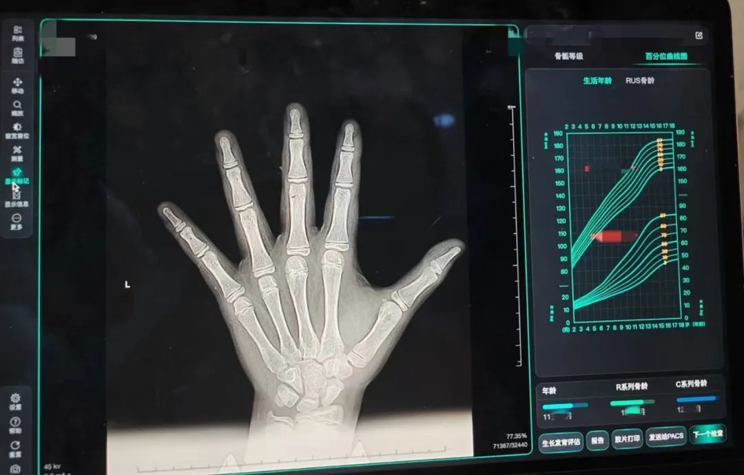 测骨龄能预测身高？骨龄超前咋办？