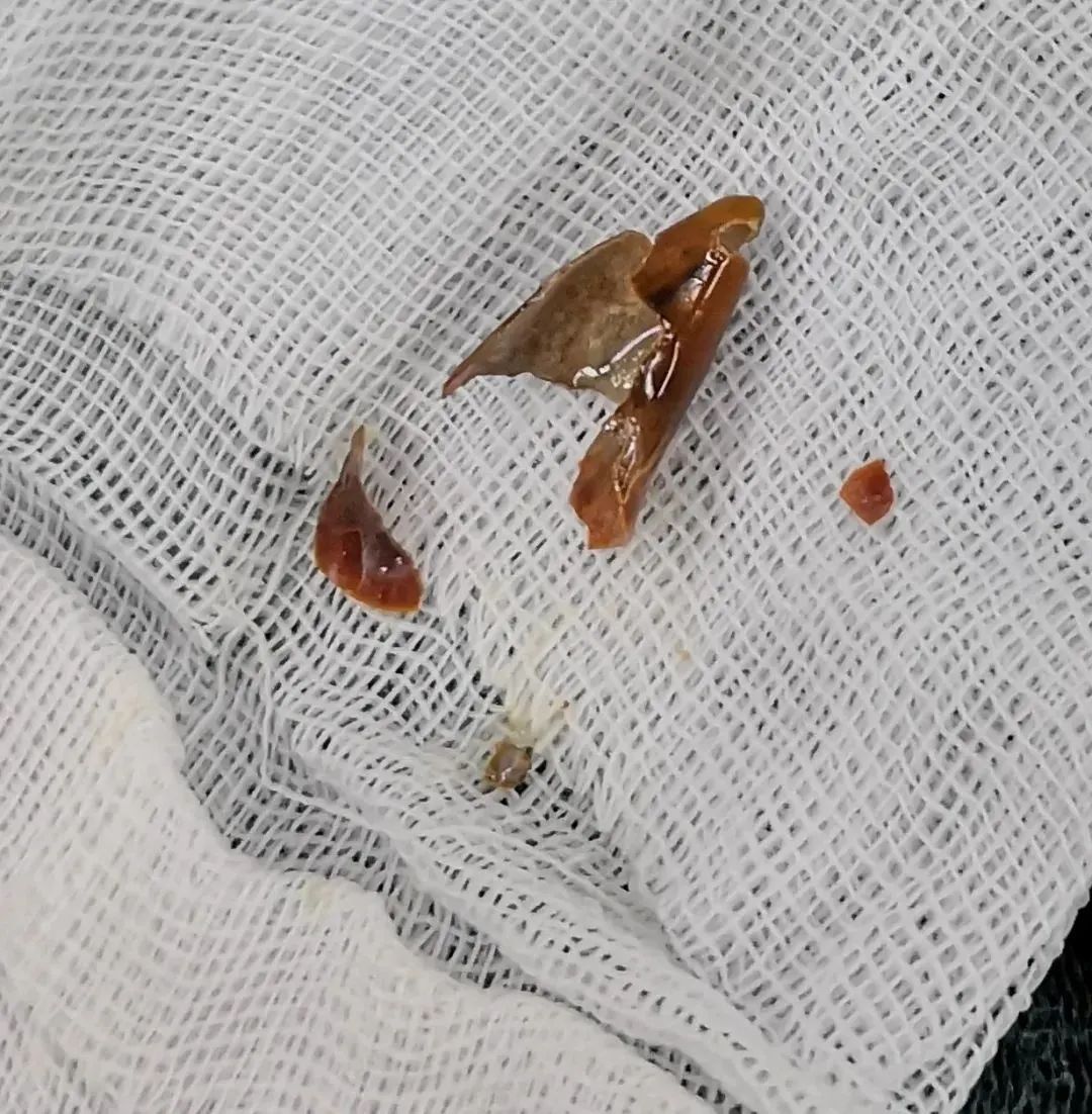 啥情况？男子夏天裹着厚棉服，高烧40℃！只因这一口辣椒...