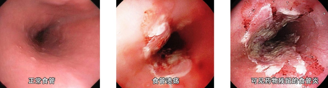 男子胸口剧痛，食管大片溃疡出血！这种服药习惯快点改