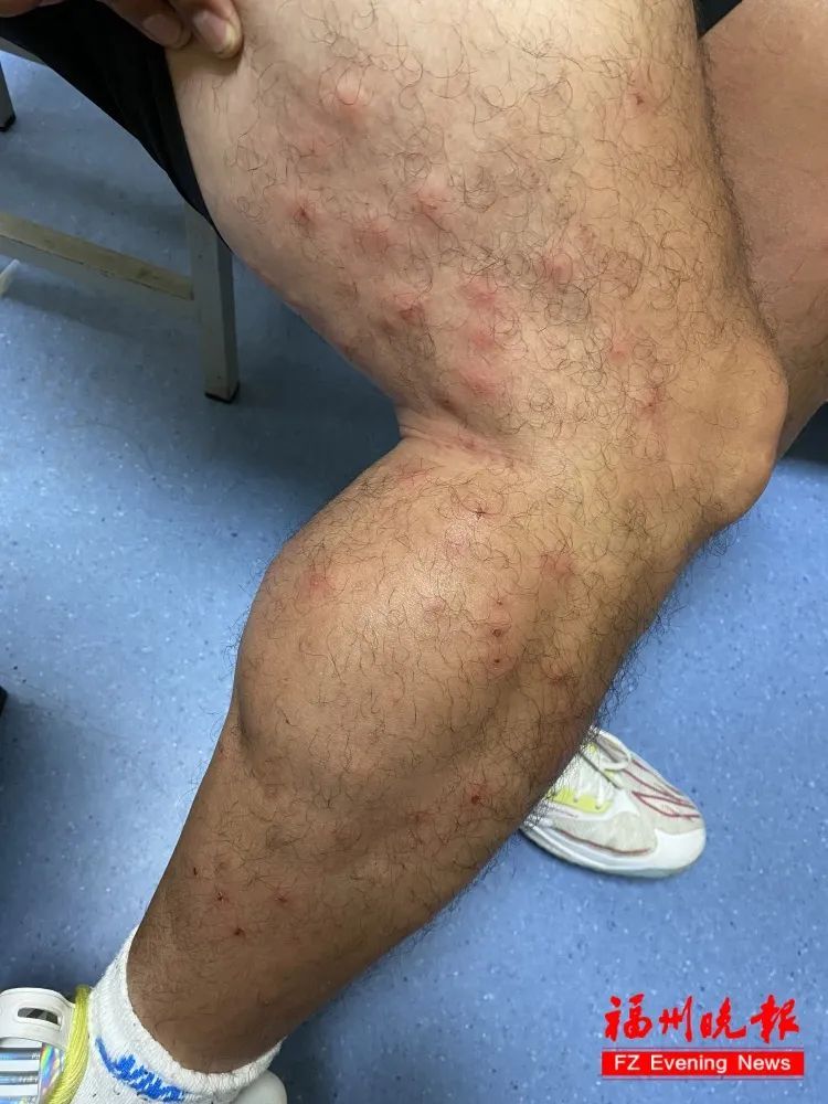 太痒了，恨不得挠破皮！福州已有人中招！医生：严重可致休克