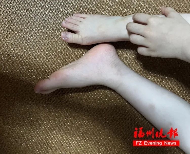 太痒了，恨不得挠破皮！福州已有人中招！医生：严重可致休克