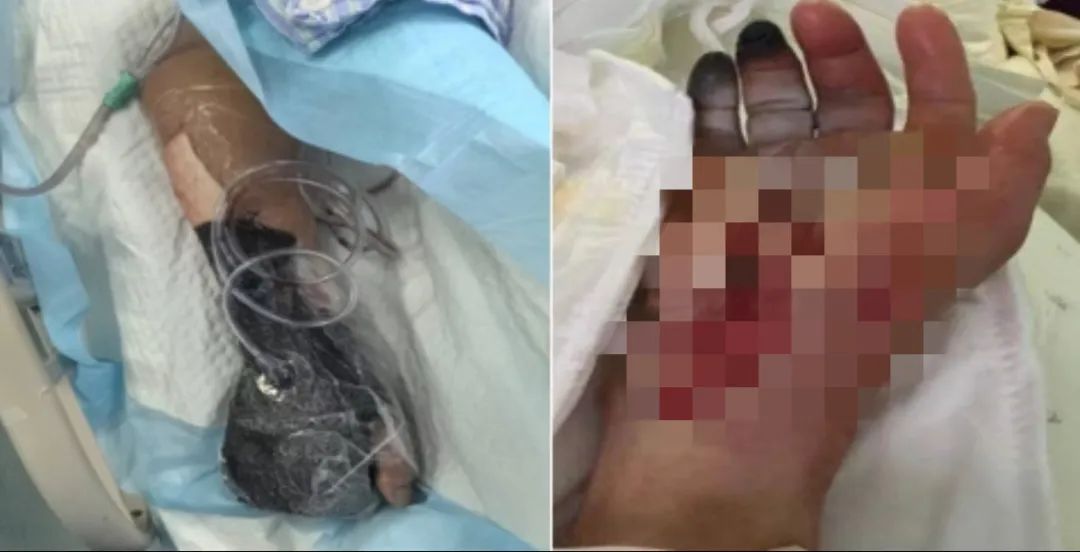 戴手套！戴手套！致死率极高……