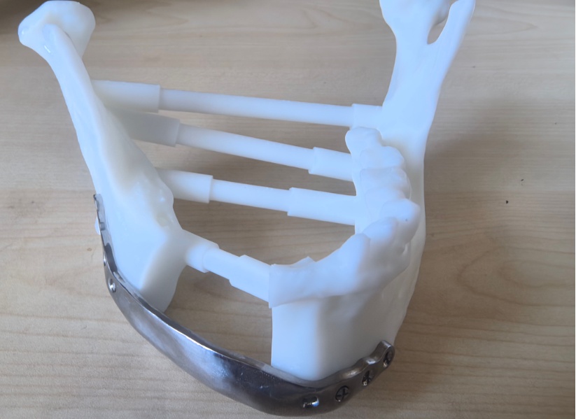 银川68岁老人颌骨被细菌“吃”掉了,牙疼千万别不当回事! 银川68岁老人颌骨被细菌“吃”掉了,牙疼千万别不当回事!