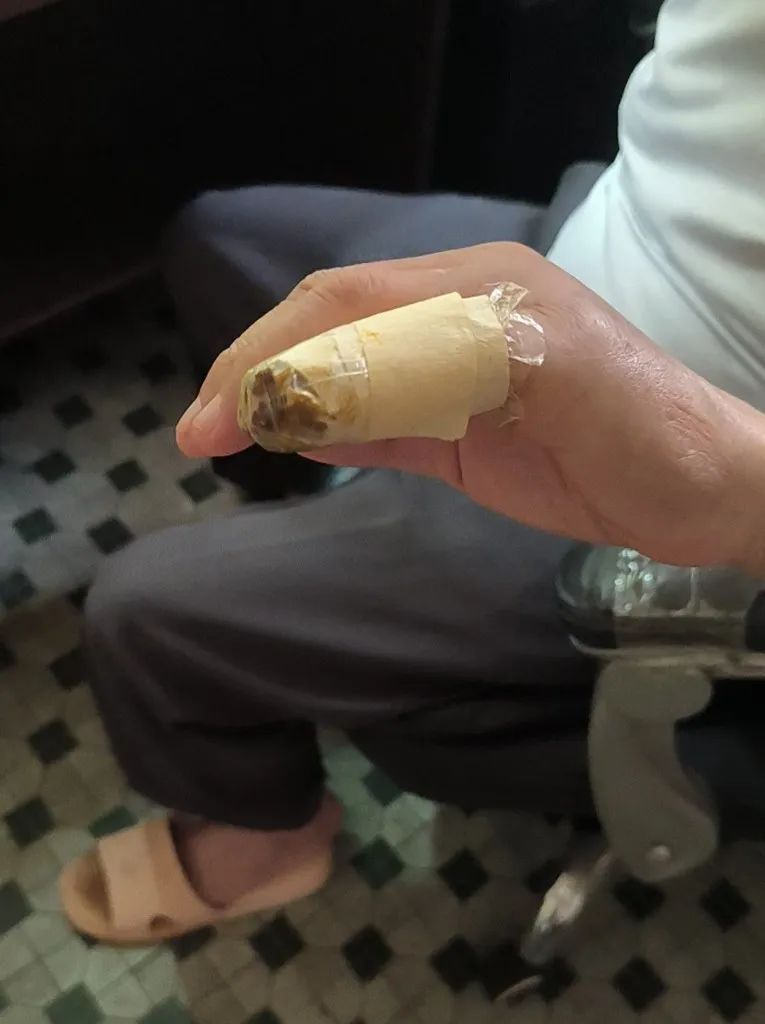 “一阵钻心的痛”,佛山九旬阿伯午休时大拇指被蜈蚣咬伤:不是第一次了 “一阵钻心的痛”,佛山九旬阿伯午休时大拇指被蜈蚣咬伤:不是第一次了