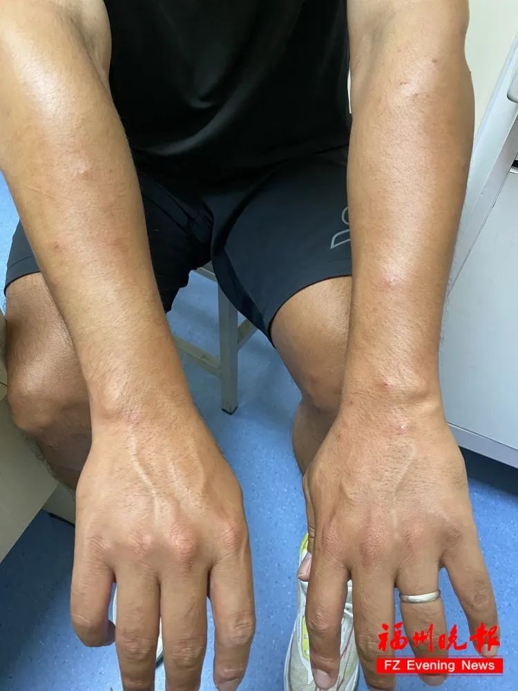 太痒了，恨不得挠破皮！福州已有人中招！医生：严重可致休克
