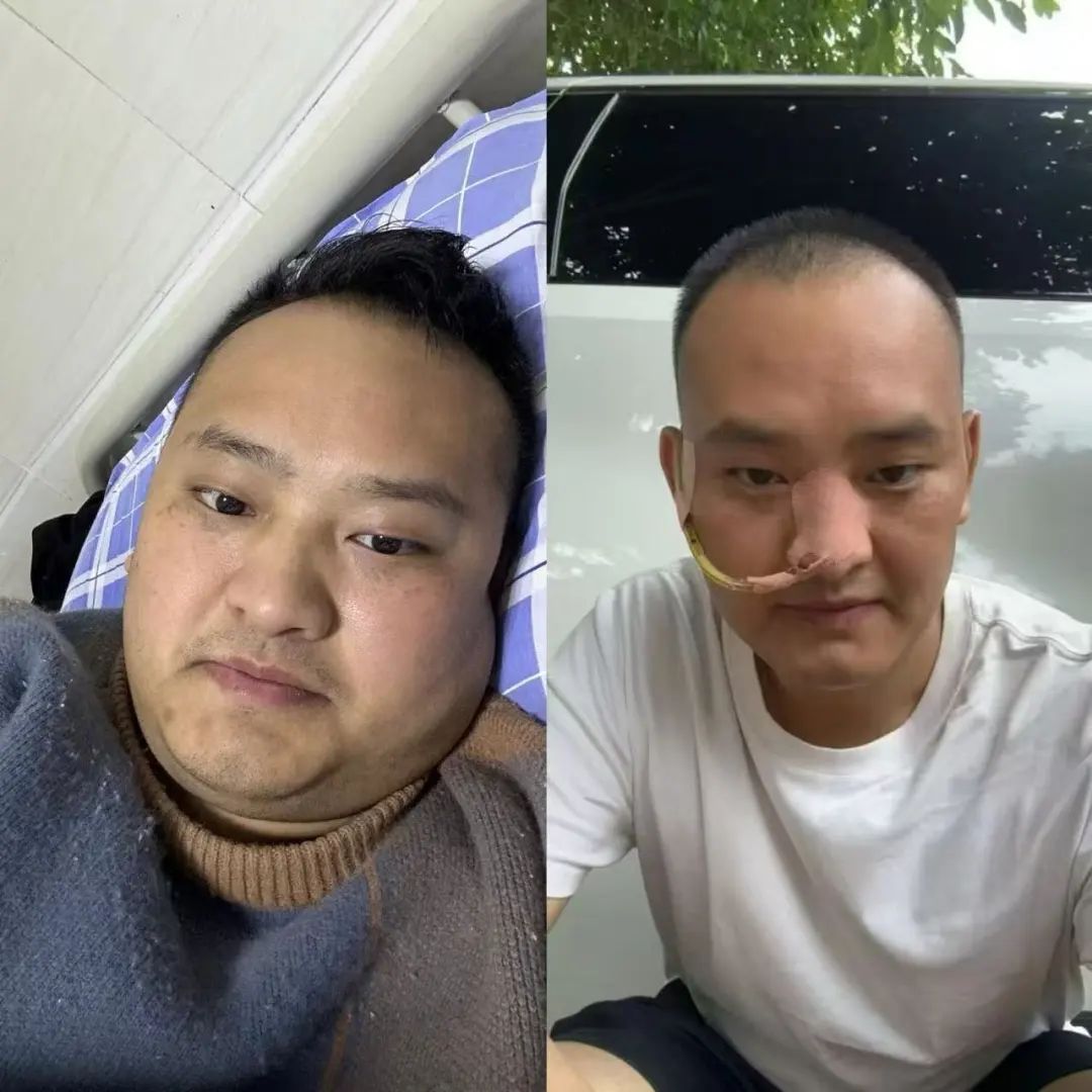 烧烤配啤酒→34岁小伙直接进了ICU,暴瘦41斤! 烧烤配啤酒→34岁小伙直接进了ICU,暴瘦41斤!