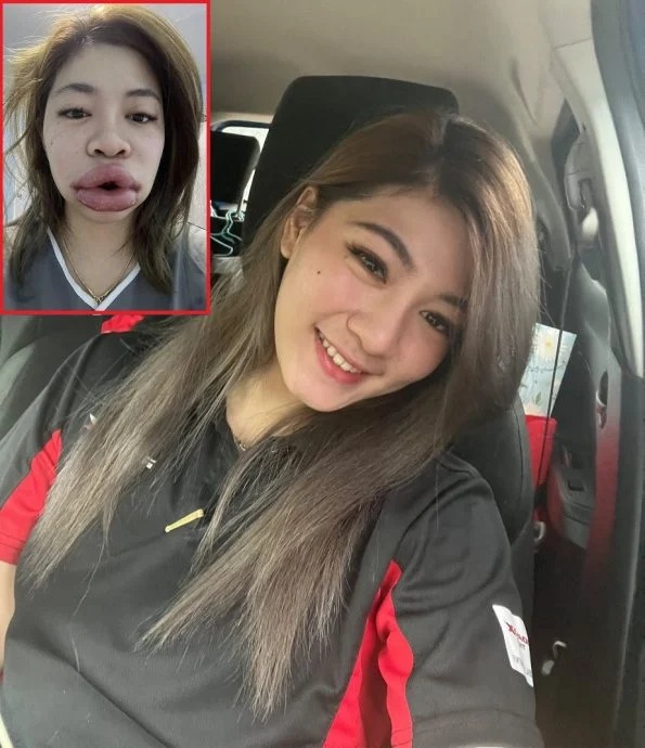 为变得更漂亮,泰国女子注射玻尿酸唇肿如香肠 为变得更漂亮,泰国女子注射玻尿酸唇肿如香肠