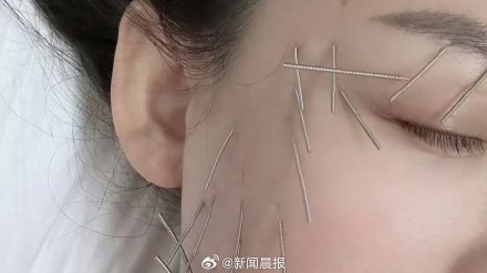 女演员同款“针雕”美容走红社媒,针灸美容是伪科学还是“真管用”? 女演员同款“针雕”美容走红社媒,针灸美容是伪科学还是“真管用”?