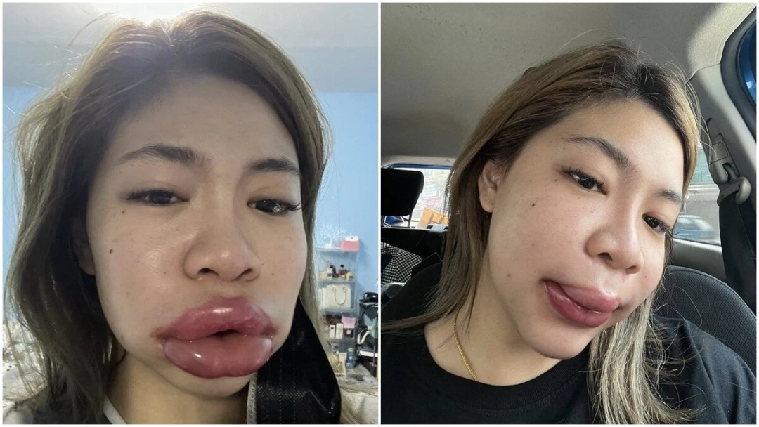 为变得更漂亮,泰国女子注射玻尿酸唇肿如香肠 为变得更漂亮,泰国女子注射玻尿酸唇肿如香肠