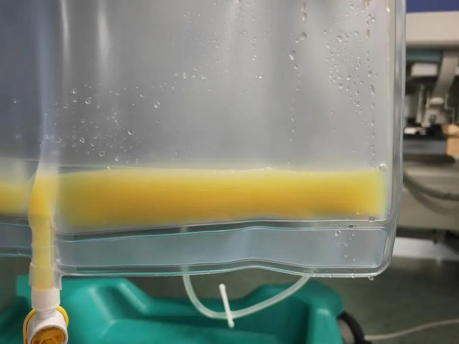 女子体内抽出2000毫升“牛奶血”,她这个习惯很多人都有! 女子体内抽出2000毫升“牛奶血”,她这个习惯很多人都有!