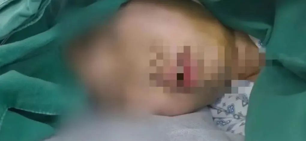 23岁女白领连续多日熬夜突发面瘫！免疫力低下患“亨特综合症”