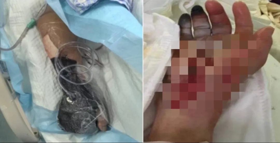 大爷清洗海鱼时被扎,不到24小时进ICU!医生提醒→ 大爷清洗海鱼时被扎,不到24小时进ICU!医生提醒→