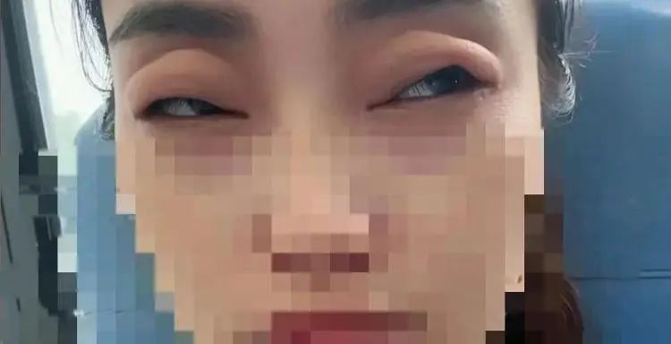 六月顶流水果，女子吃完秒变“悲伤蛙” ！医生：罕见却凶险