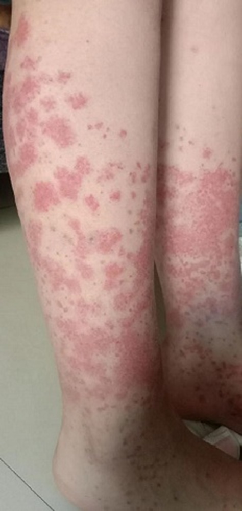 20岁爱美姑娘浑身长满紫斑,还要剃光头!只因每个月做这件事 20岁爱美姑娘浑身长满紫斑,还要剃光头!只因每个月做这件事