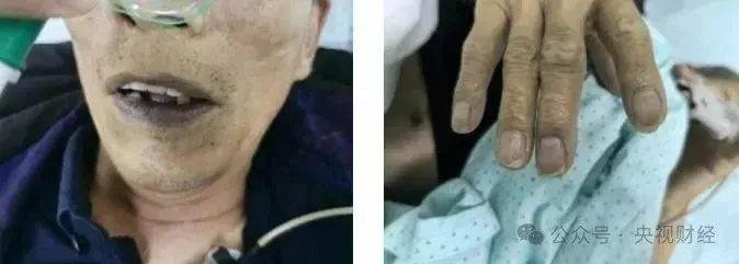 一碗下肚，中毒变“紫”了！这道菜很多人爱吃……