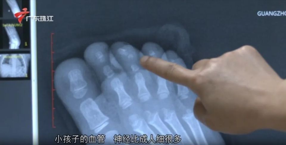 又是洞洞鞋惹的祸！广东3岁女童被电梯夹断脚趾，家长悔不当初