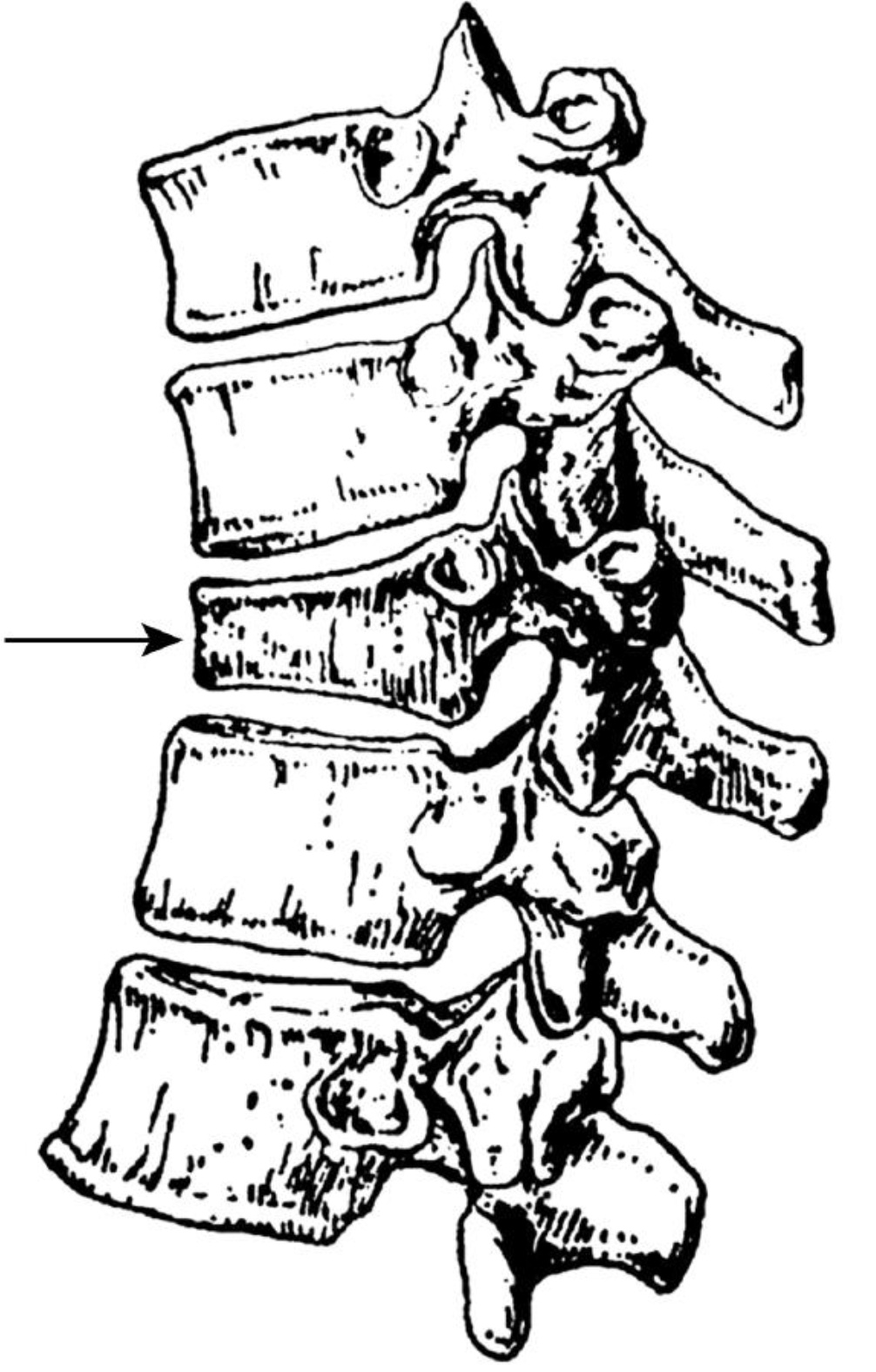 骨质疏松的老年人需警惕 梅雨季这种疾病高发 骨质疏松的老年人需警惕 梅雨季这种疾病高发