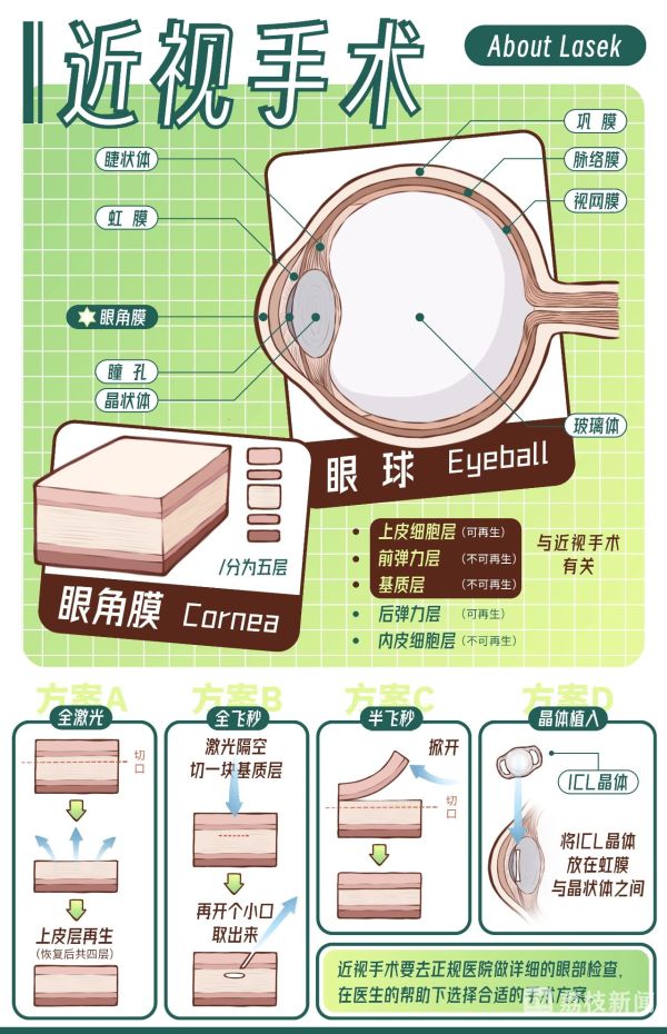 高考后“摘镜热”！四大近视手术深度PK，一篇看懂不迷茫