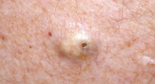 警惕！身上长了这种"小凸起", 千万别随便抠！