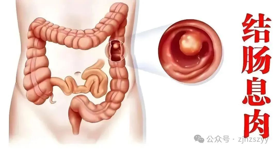 密密麻麻!杭州女子体内满是“葡萄”…差点拖成癌!医生:尽早处理 密密麻麻!杭州女子体内满是“葡萄”…差点拖成癌!医生:尽早处理