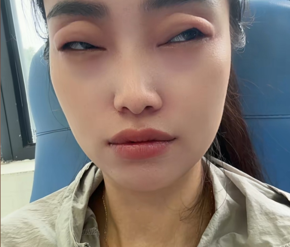 2颗下肚,女子眼睛差点看不见了!正大量上市,有人吃到抢救…… 2颗下肚,女子眼睛差点看不见了!正大量上市,有人吃到抢救……