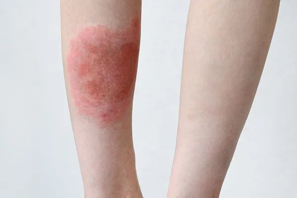 危险!身上忽然冒出这种小黑点,要尽快处理,千万别大意! 危险!身上忽然冒出这种小黑点,要尽快处理,千万别大意!