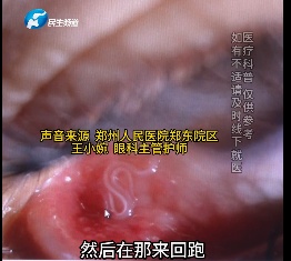 女子揉眼后拽出2条活虫,医生紧急提醒!有这些习惯的一定注意 女子揉眼后拽出2条活虫,医生紧急提醒!有这些习惯的一定注意