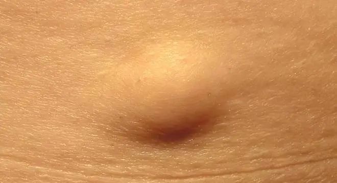 警惕！身上长了这种"小凸起", 千万别随便抠！