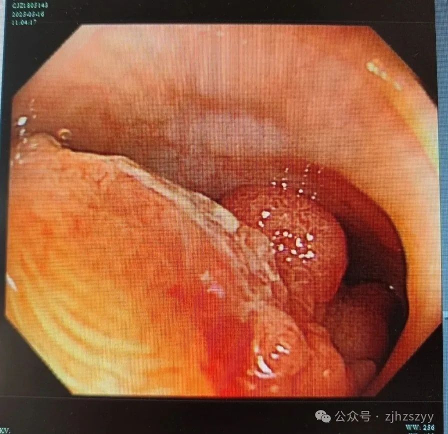 密密麻麻!杭州女子体内满是“葡萄”…差点拖成癌!医生:尽早处理 密密麻麻!杭州女子体内满是“葡萄”…差点拖成癌!医生:尽早处理