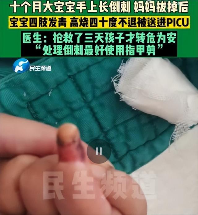 手上这根“刺”拔不得!不当处理会越长越多 手上这根“刺”拔不得!不当处理会越长越多