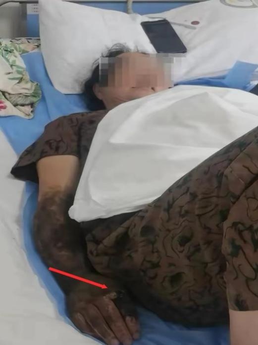 被毒蛇咬伤,这个“救命”动作帮了大忙! 被毒蛇咬伤,这个“救命”动作帮了大忙!