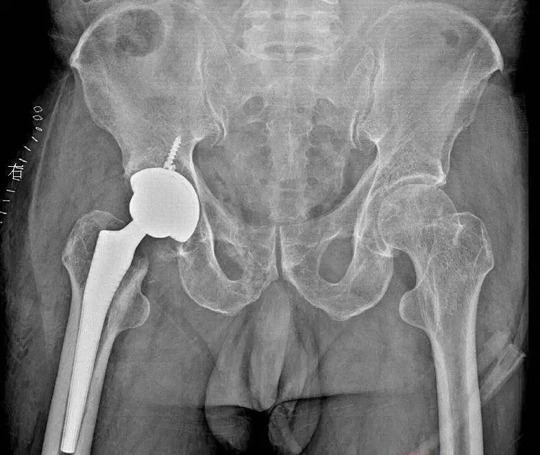 “酒友”需警惕!镇江“2斤哥”干废股骨头 “酒友”需警惕!镇江“2斤哥”干废股骨头