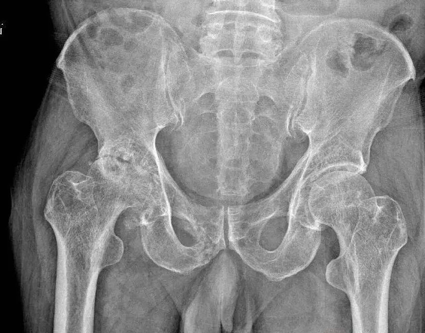 “酒友”需警惕!镇江“2斤哥”干废股骨头 “酒友”需警惕!镇江“2斤哥”干废股骨头