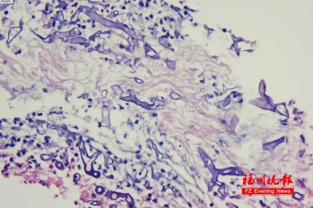 鼻痛、眼肿、侧瘫 早期症状似感冒 认识凶险潜伏的“毛霉菌病” 鼻痛、眼肿、侧瘫 早期症状似感冒 认识凶险潜伏的“毛霉菌病”