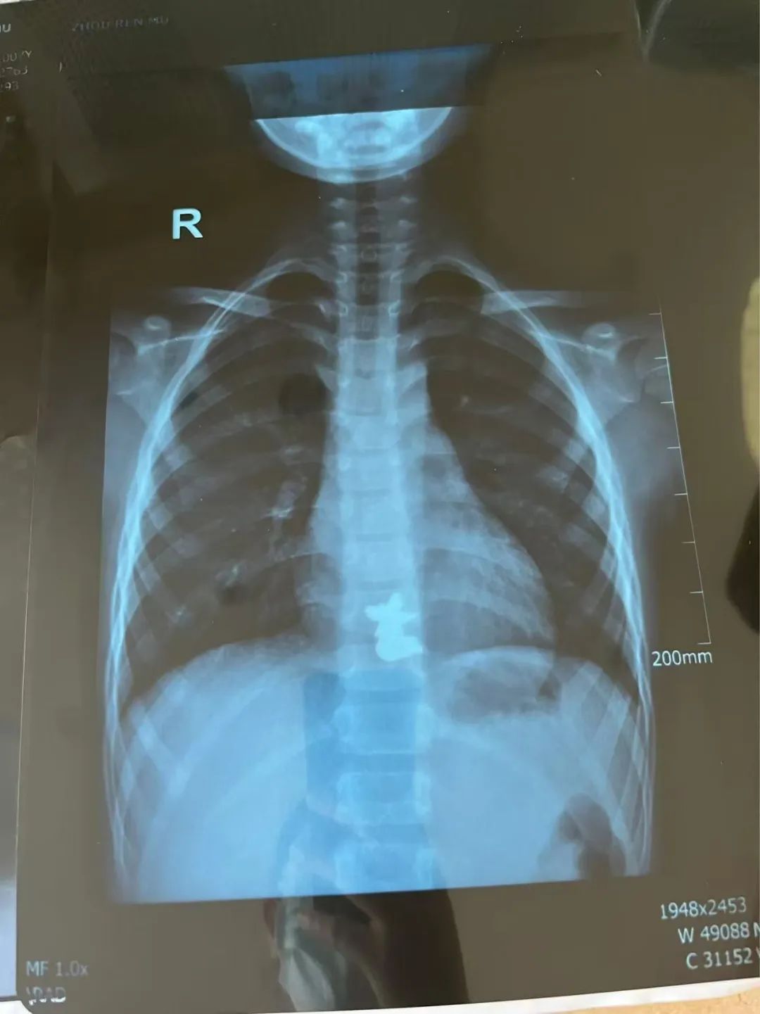 近期频发!一个月接诊近20例误食“少先队队徽或其磁铁”儿童 近期频发!一个月接诊近20例误食“少先队队徽或其磁铁”儿童