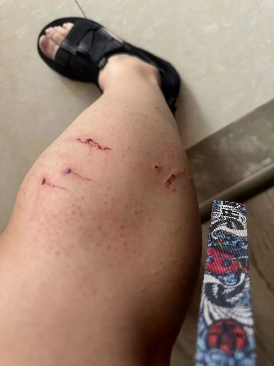沪上一女子腿上被咬出4个血洞!小区内成群结队、危机四伏,不少人中招 沪上一女子腿上被咬出4个血洞!小区内成群结队、危机四伏,不少人中招