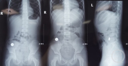 吞服两枚队徽磁铁 男孩4处肠穿孔!医院一个多月已接诊近20例误食 吞服两枚队徽磁铁 男孩4处肠穿孔!医院一个多月已接诊近20例误食