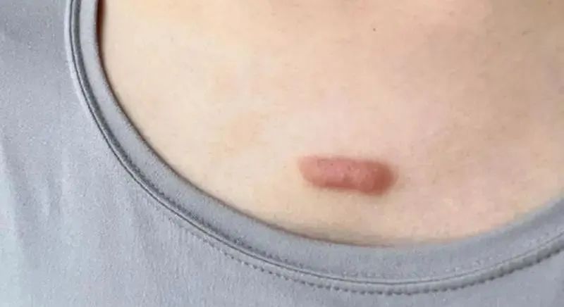 警惕!身上长了这种“小凸起”, 千万别随便抠! 警惕!身上长了这种“小凸起”, 千万别随便抠!