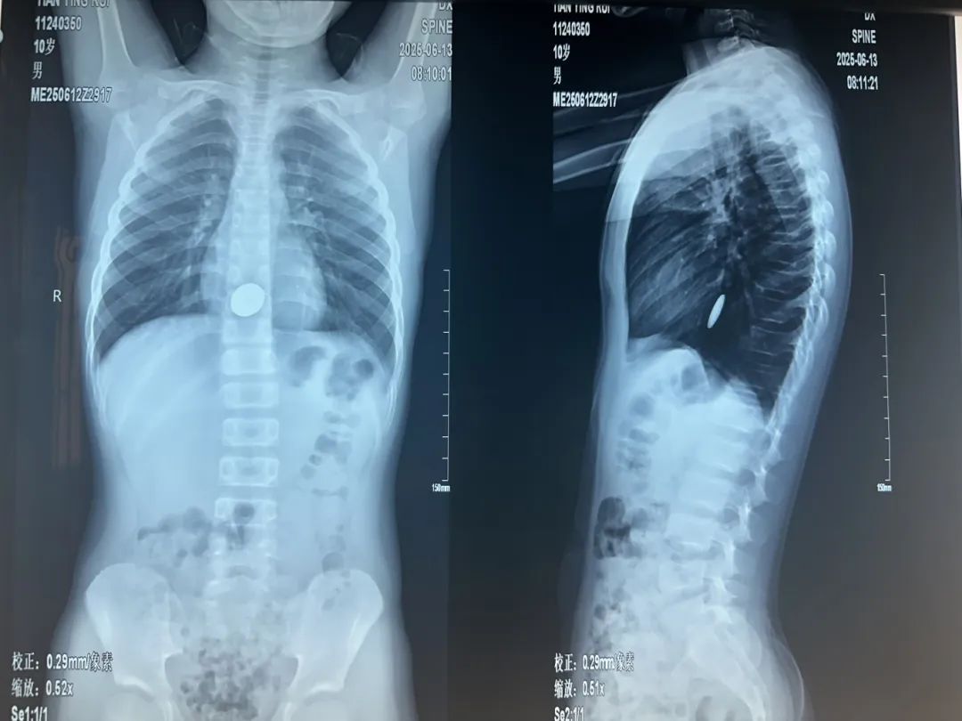 近期频发!一个月接诊近20例误食“少先队队徽或其磁铁”儿童 近期频发!一个月接诊近20例误食“少先队队徽或其磁铁”儿童