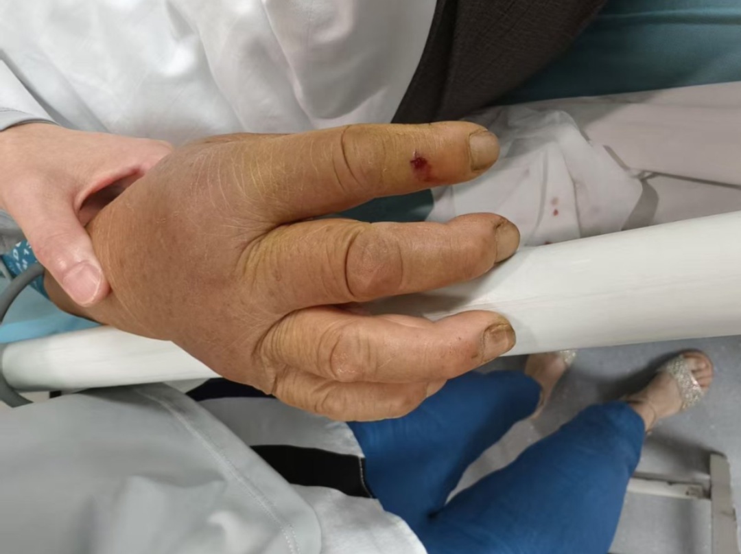 老人疑遭蛇咬仍“淡定”干活2小时 医生直呼危险 老人疑遭蛇咬仍“淡定”干活2小时 医生直呼危险