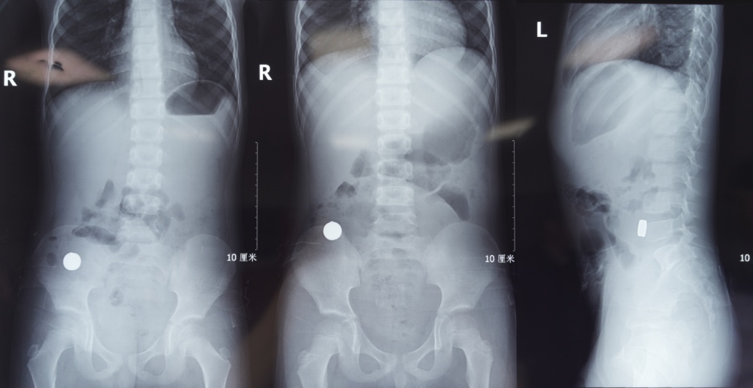 近期频发!一个月接诊近20例误食“少先队队徽或其磁铁”儿童 近期频发!一个月接诊近20例误食“少先队队徽或其磁铁”儿童