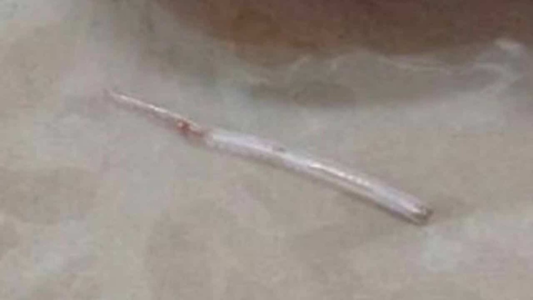 泰国女子喝鱼汤被鱼刺卡喉,按摩痛处时,鱼刺竟直接刺穿脖子 泰国女子喝鱼汤被鱼刺卡喉,按摩痛处时,鱼刺竟直接刺穿脖子