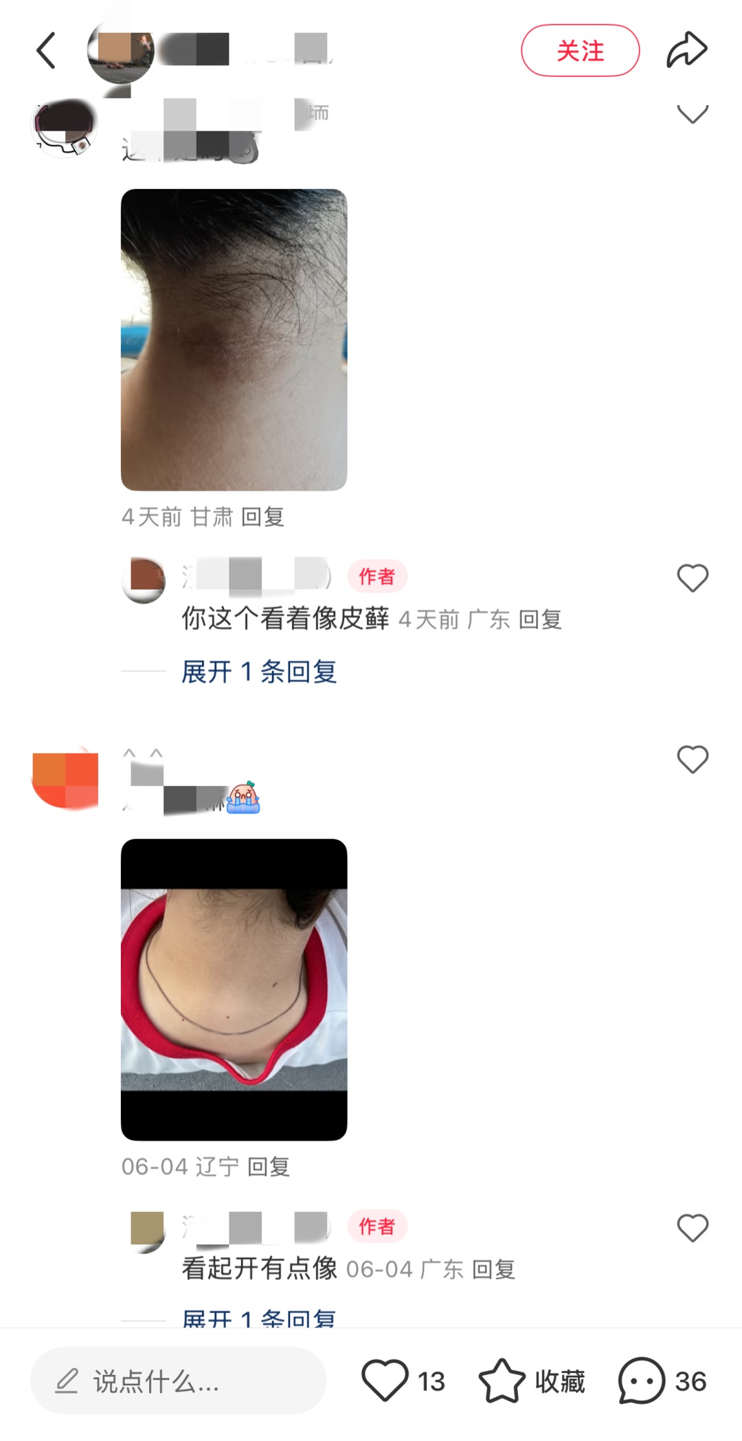 网友晒照求诊:“黑脖子”是胰岛素抵抗?专家:不可靠! 网友晒照求诊:“黑脖子”是胰岛素抵抗?专家:不可靠!